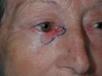 Tumor del párpado inferior en su sector nasal. Delimitación de su tamaño macroscópico. Esta zona se extirpa en forma completa.