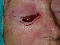 Se extripa un margen de 1 a 2 mm rodeando la lesión y su base, de esta manera, todos los bordes del tumor serán examinados