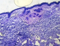 En este preparado se observa en la zona superior, debajo de la epidermis, varios cordones de carcinoma Basocelular (los acúmulos violáceos). Esos pequeños islotes son difíciles de identificar con otras técnicas