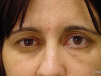 caso 3 Parálisis facial izquierda