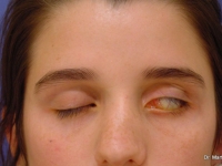 caso 1 Incapacidad para cerrar el ojo (lagoftalmos)