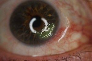 ulcera corneal