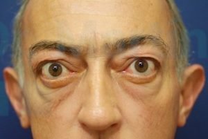 tiroides y ojos