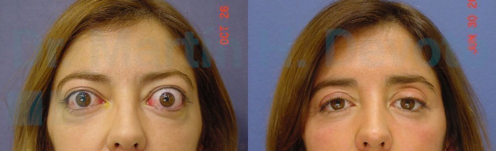 tiroides y ojos 5